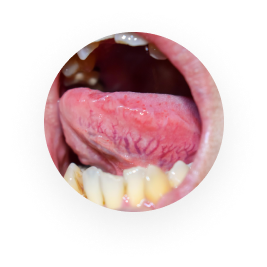 Mouth Ulcers